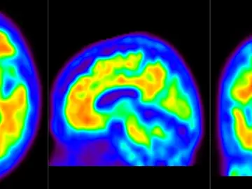 imágenes de escáner cerebral con PET amiloide. imágenes de escáner cerebral con PET amiloide.