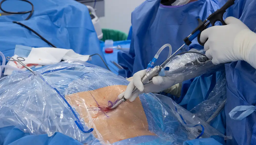 La incisión de entre 0,8 centímetros y 1 centímetro utilizada para llegar a la zona dañada en la técnica quirúrgica de la endoscopia de columna, en una operación del doctor Miguel Ángel Castrillo en una intervención el pasado martes en el Hospital Ramón y Cajal de Madrid