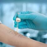 El estudio ha analizado 249 casos de alérgicos a betalactámicos de siete hospitales