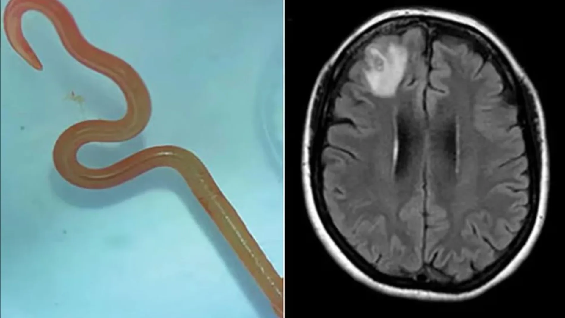 El gusanoque los cirujanos del hospital de Canberra extrajeron viva del cerebro de la mujer.