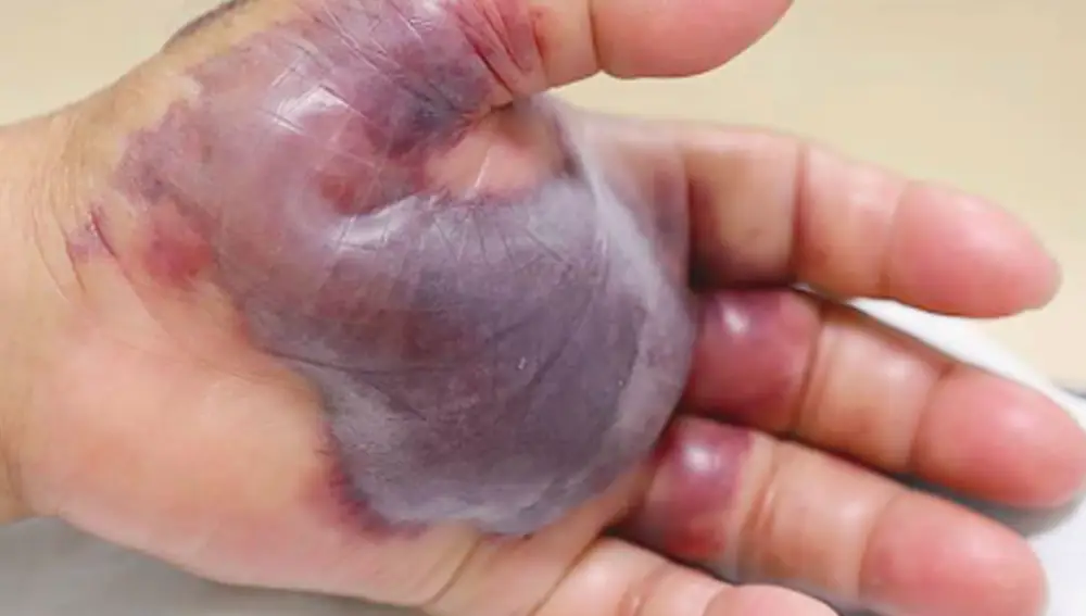 Fotografía de una persona afectada por una infección por vibrio vulnificus