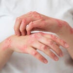 La psoriasis afecta a un millón de personas en España y puede tener relación con lo cardiovascular