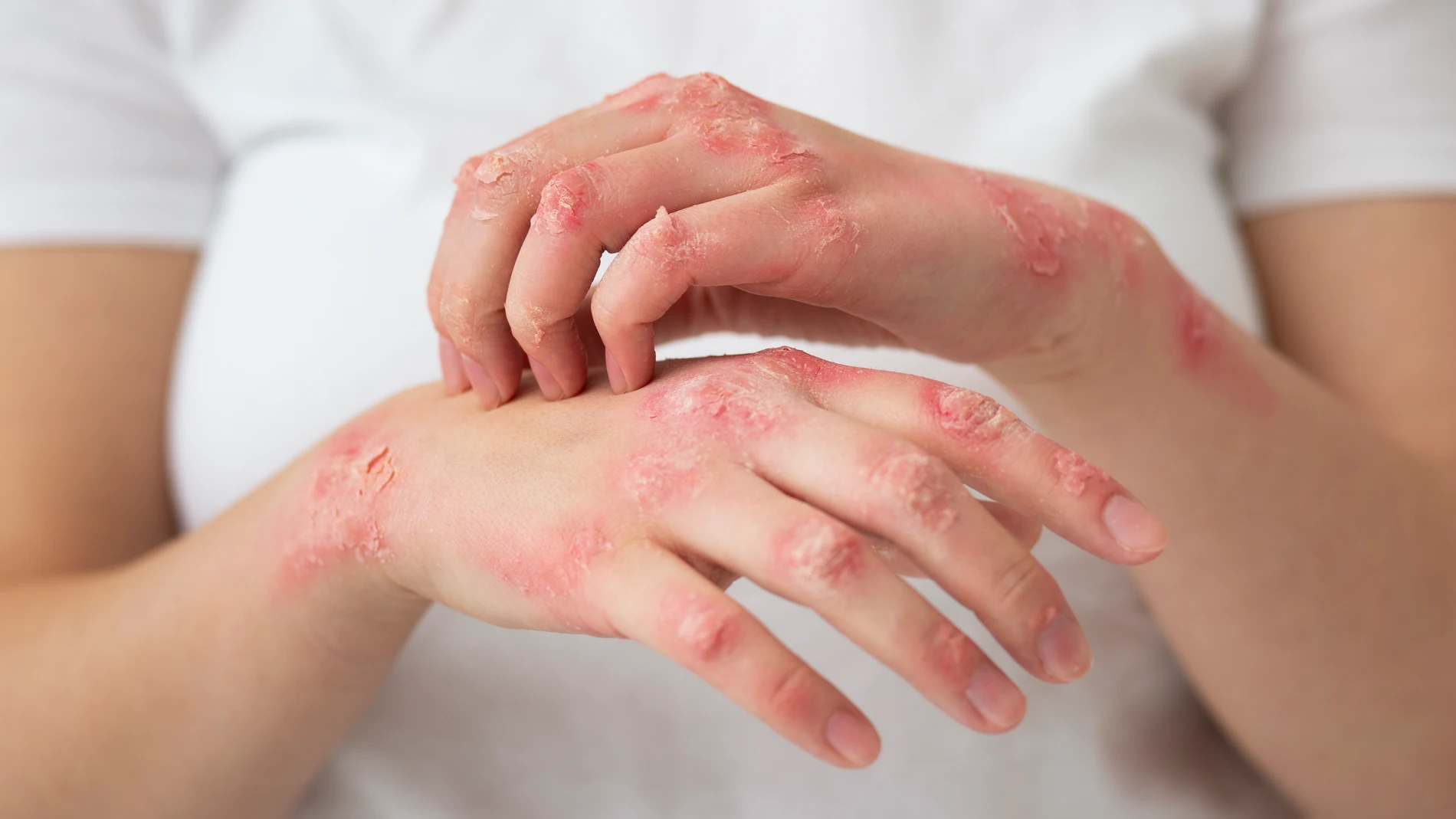 psoriasis