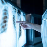 Radiografía de cáncer de pulmón