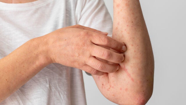 El herpes zóster viene del mismo virus de la varicela