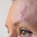 Mujer con el herpes Zoster en la frente