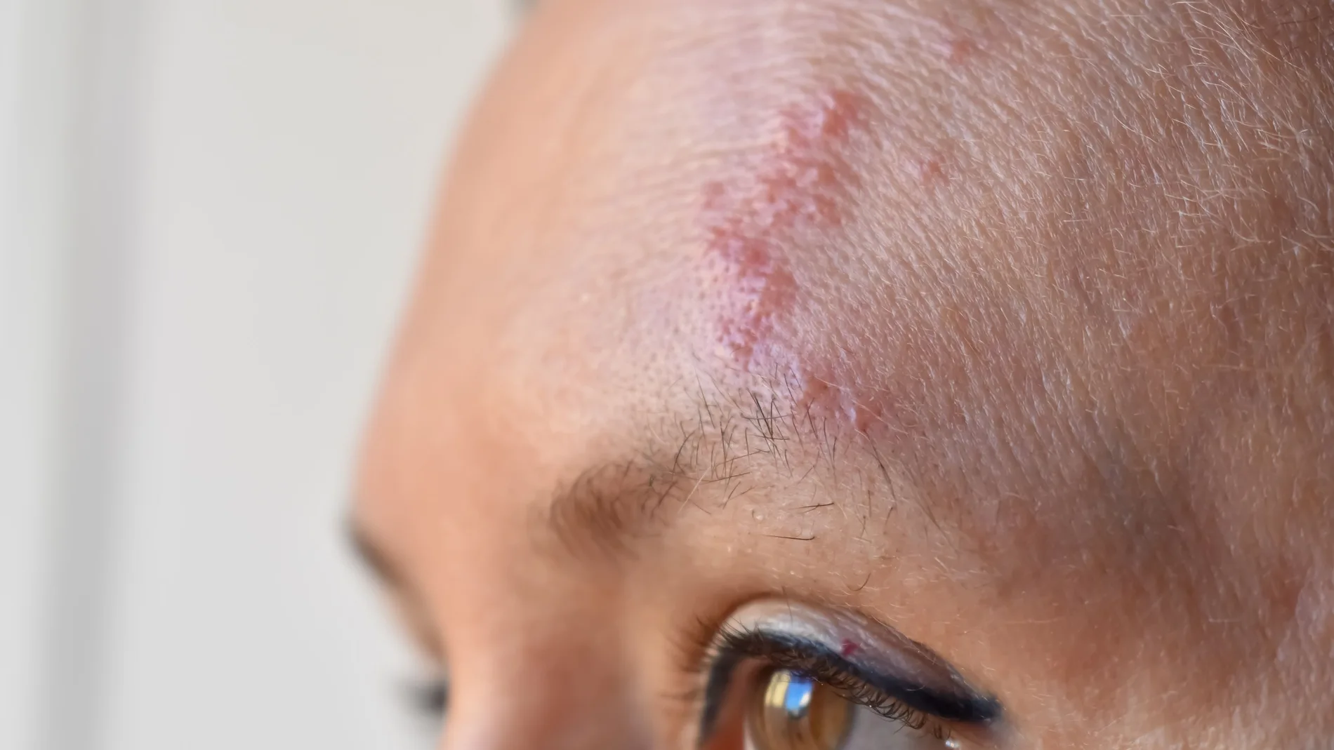 Mujer con el herpes Zoster en la frente
