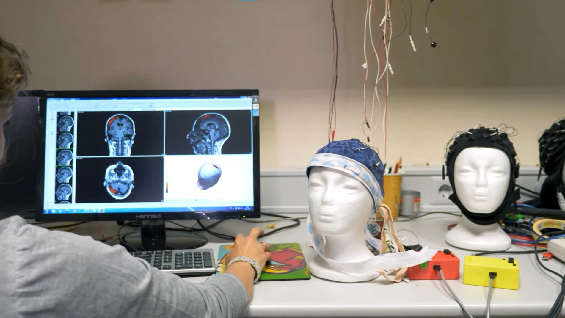 El desarrollo de neuroprótesis cerebrales es una necesidad ya que puede ofrecer una solución para muchas personas ciegas