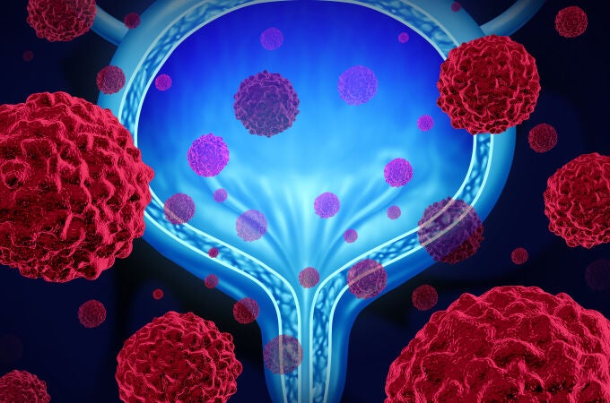 Cáncer de vejiga Cáncer de vejiga