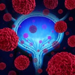 Cáncer de vejiga