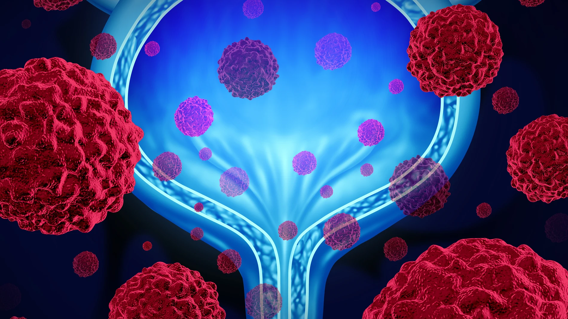 Cáncer de vejiga