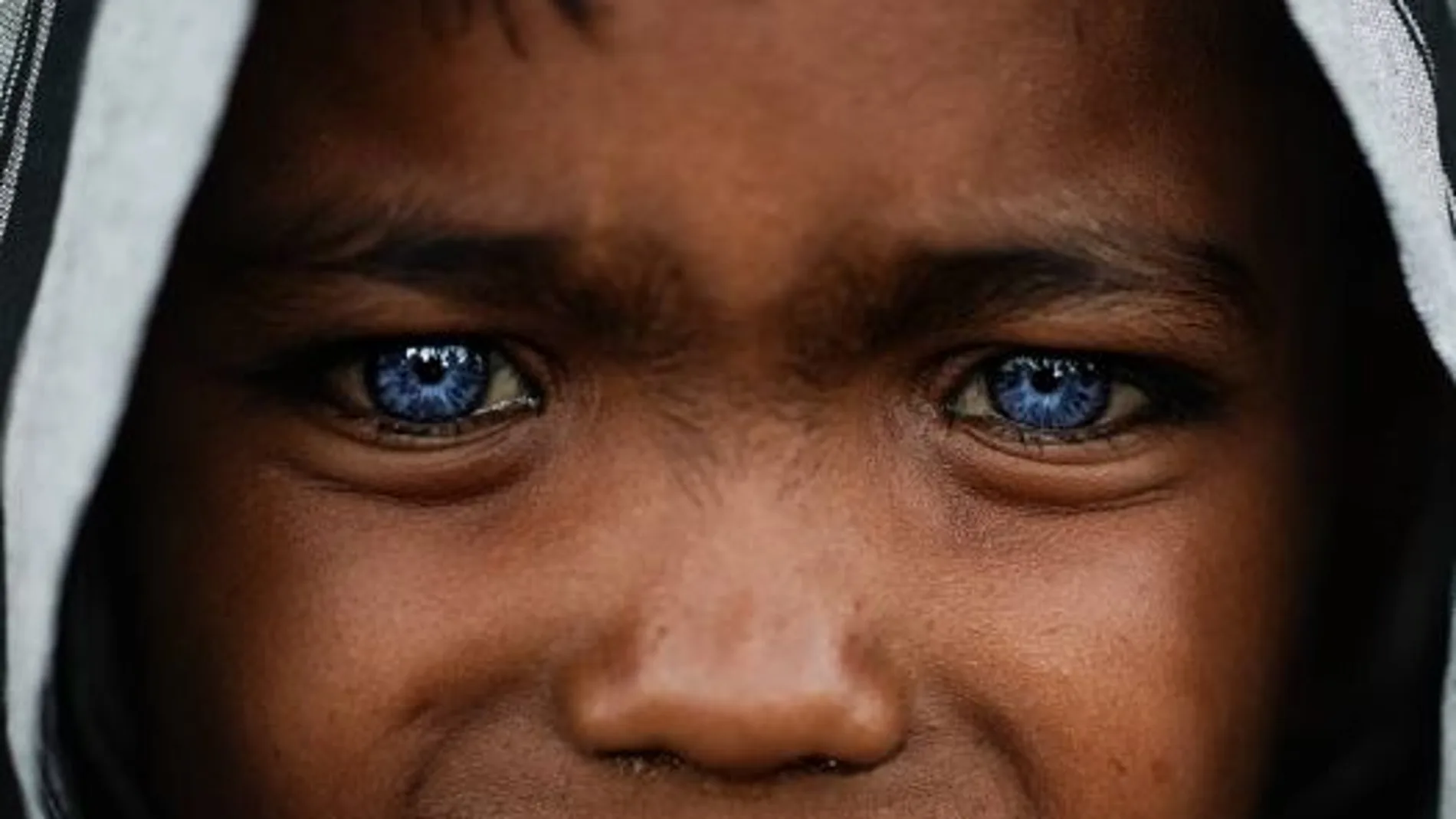 Esta condición genética única se conoce como Síndrome de Waardenburg