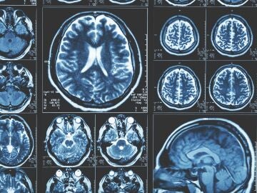 Cerebro con parkinson