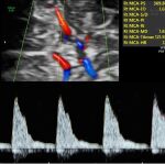 Ecografía Doppler del estudio internacional multicéntrico