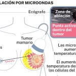 Termoablación por microondas de tumor de mama