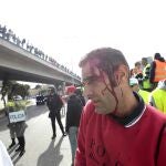 Uno de los agricultores heridos durante las cargas policiales en Algeciras 
