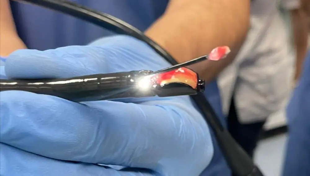 Sonda de Criobiopsia con la muestra de tejido extraído por los neumólogos de la cavidad torácica destinada a estudio en el Laboratorio de Anatomía Patológica