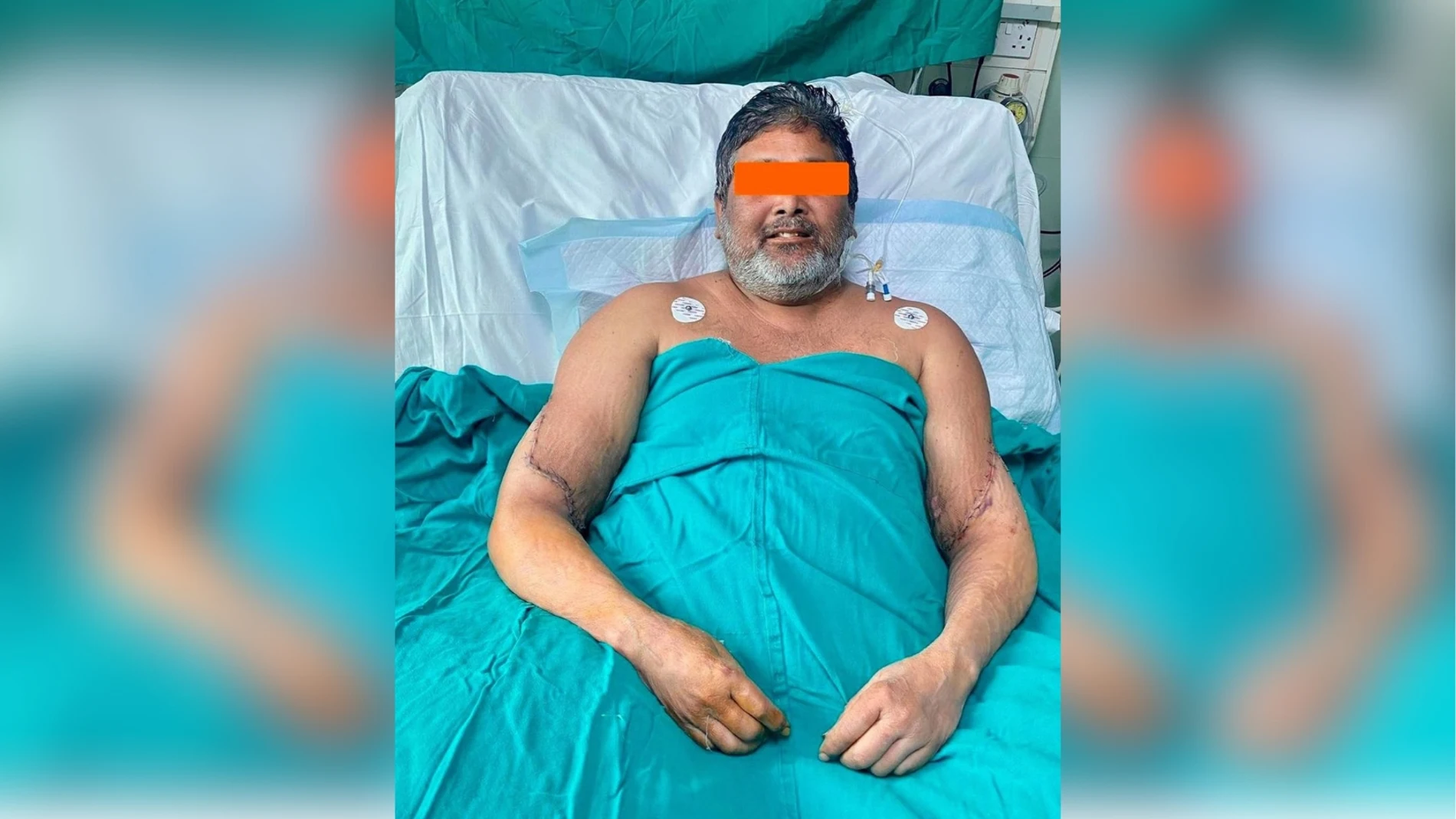 Un pintor que había perdido ambas manos volverá a pintar gracias a un doble trasplante