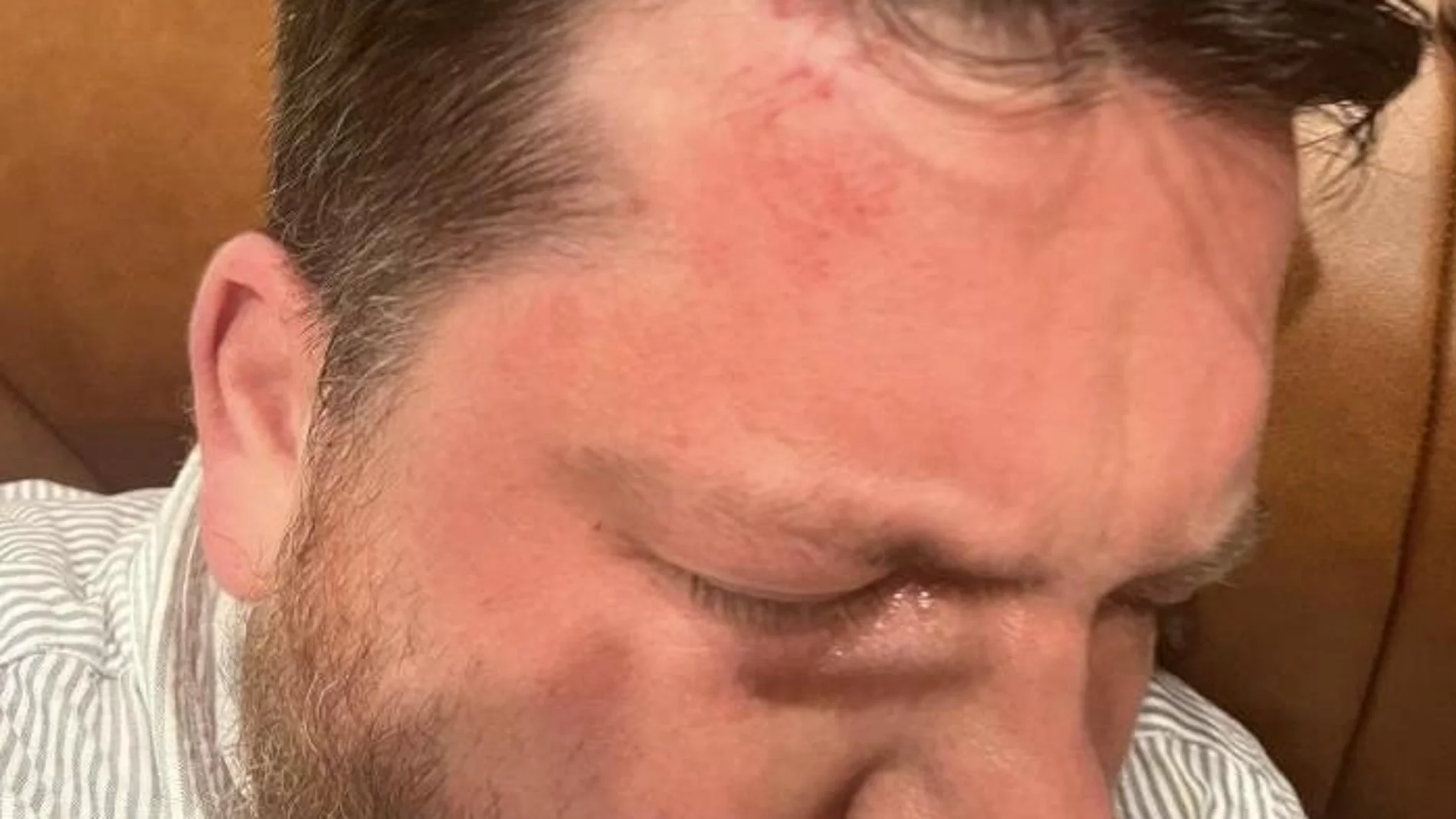Leonid Volkov, jefe de equipo del líder opositor ruso Alexéi Navalni, tras ser golpeado en Lituania