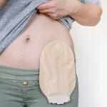 Ostomía