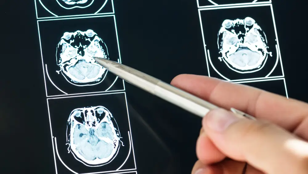 Radiografía del cerebro