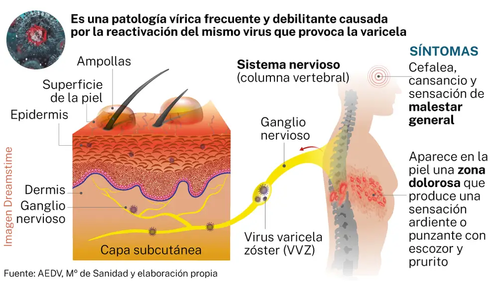 Herpes zóster