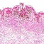 Melanoma