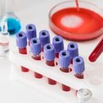 Un nuevo estudio apunta a la posibilidad de diagnosticar la enfermedad con un análisis