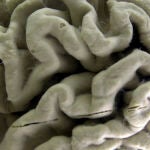 Alzheimer's Gene