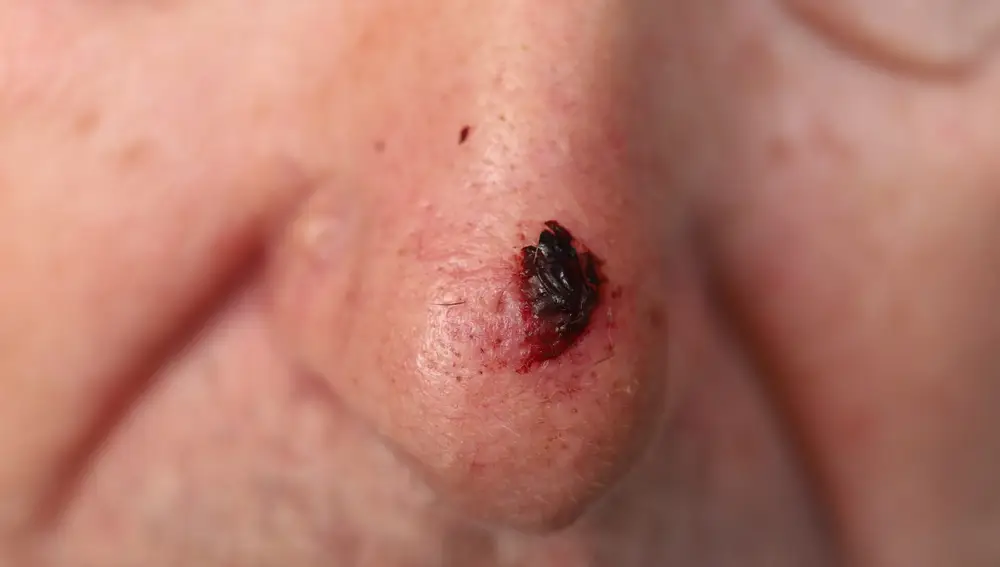 Carcinoma basocelular