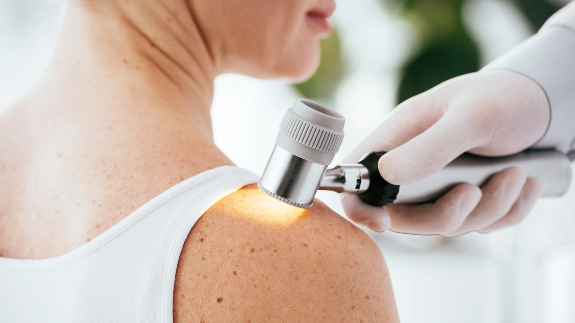 Especialista en dermoestética explica en qué consiste la ‘regla ABCDE’