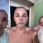 La reacción viral de un hombre después de su trasplante capilar