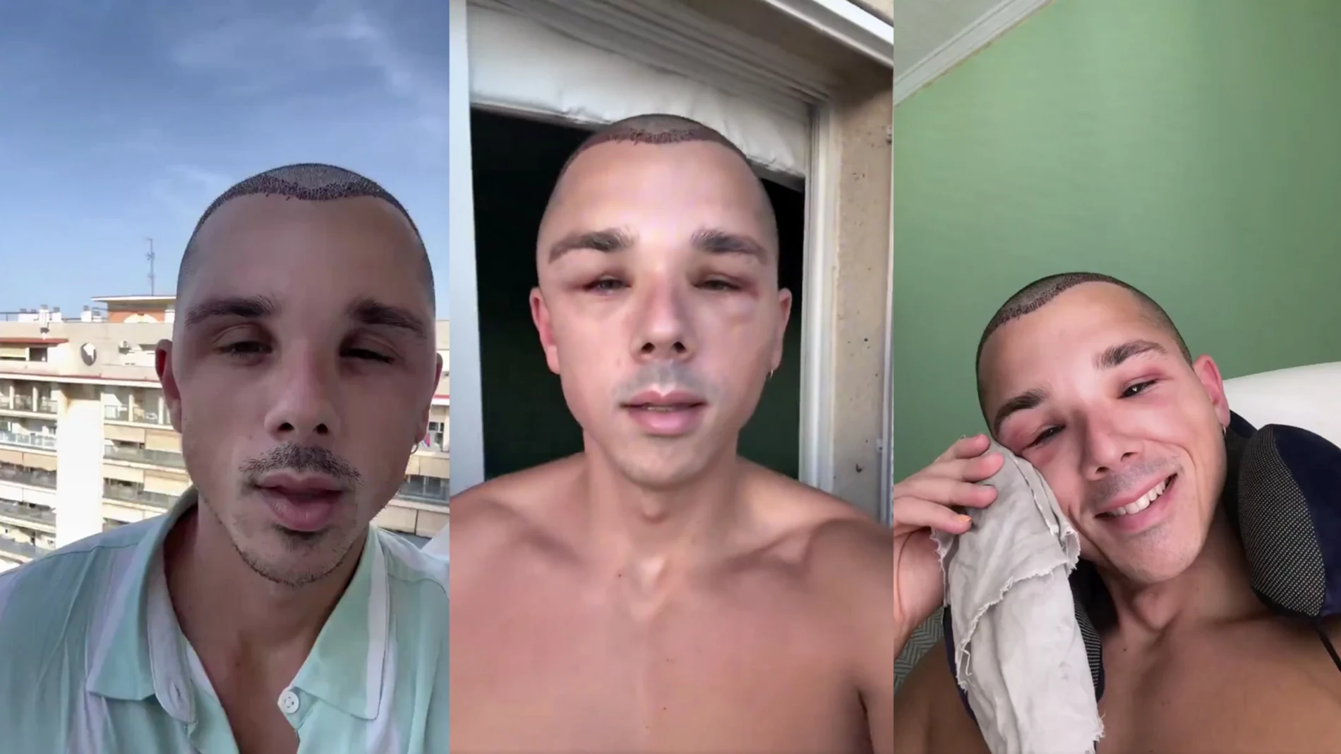La reacción viral de un hombre después de su trasplante capilar