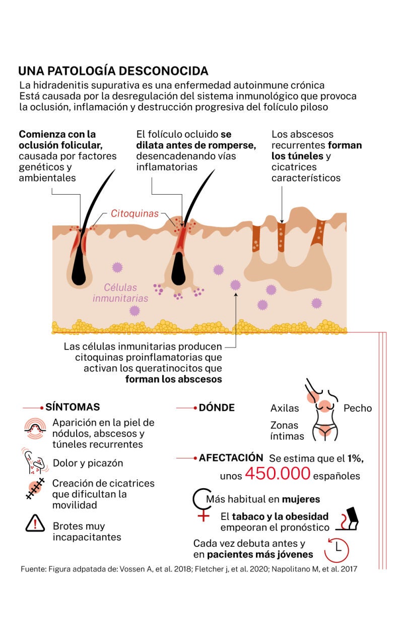 Hidradermitis supurativa