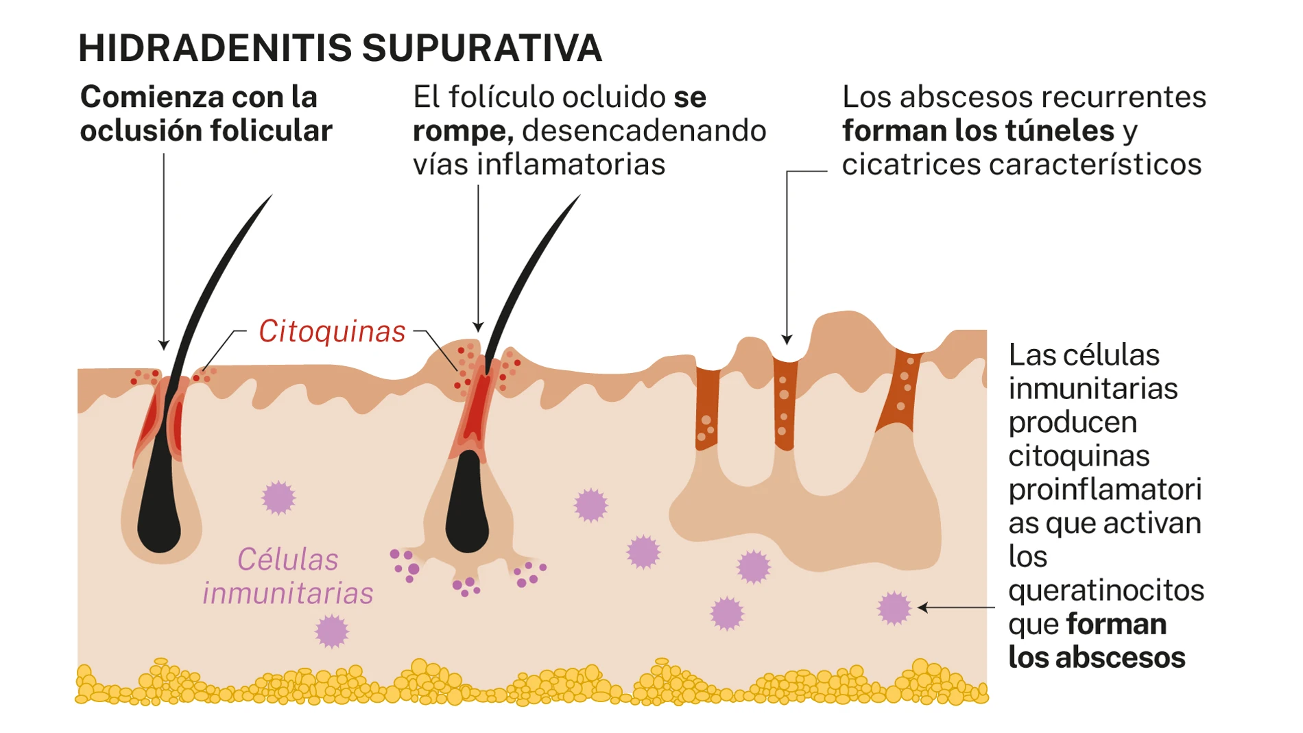 Hidradenitis supurativa