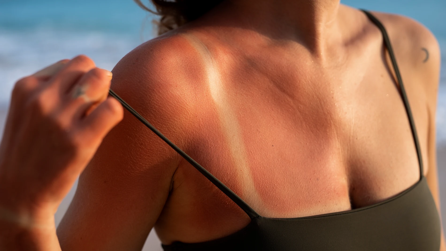 Una mujer muestra las marcas que le han quedado por el sol