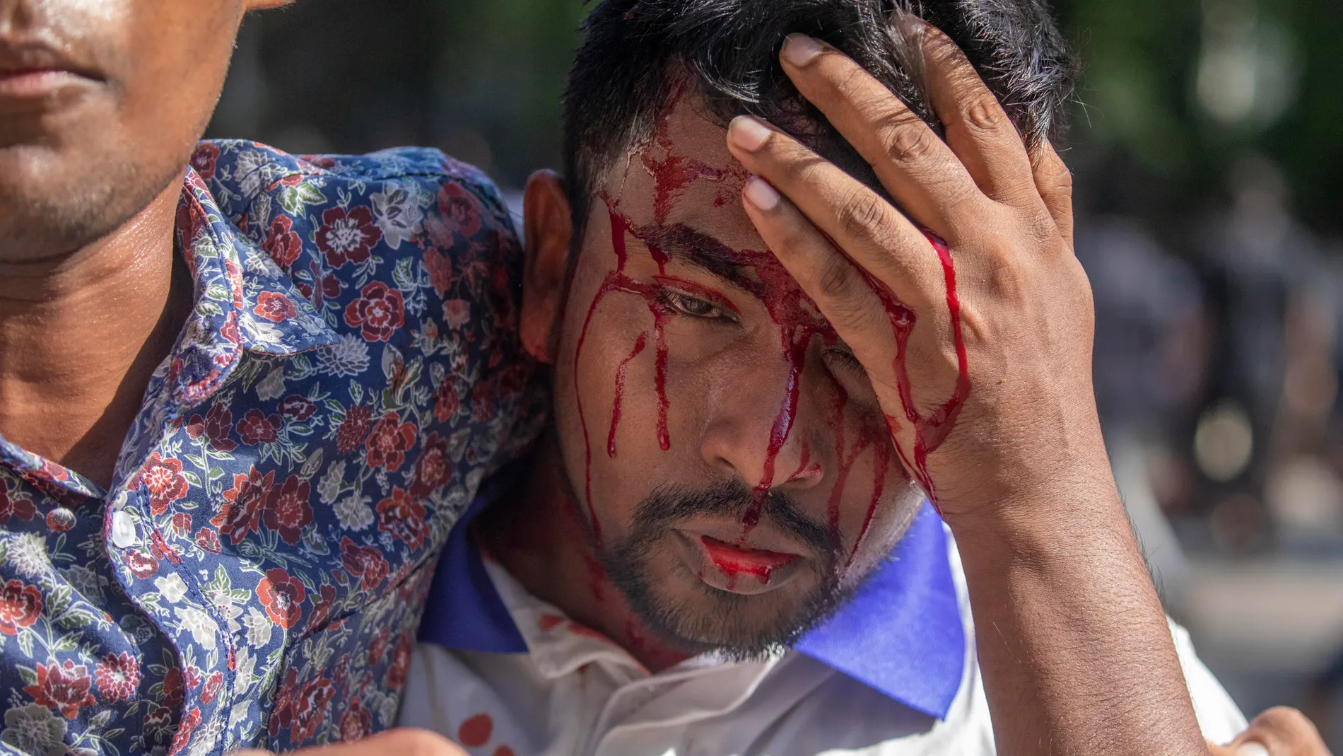 Dhaka, (Bangladesh), 15/07/2024.- An injured person is bleeding as quota protesters clash with Bangladesh Chhatra League (BCL) activists in Dhaka, Bangladesh, 15 July 2024. Hundreds of students were injured in clashes allegedly between quota reform protesters and Dhaka University (DU) unit Chhatra League activists at Dhaka University Campus. The students protested under the banner of the 'Anti-Discrimination Student Movement' called a 'Bangla Blockade', as they blocked intersections in Dhaka ...
