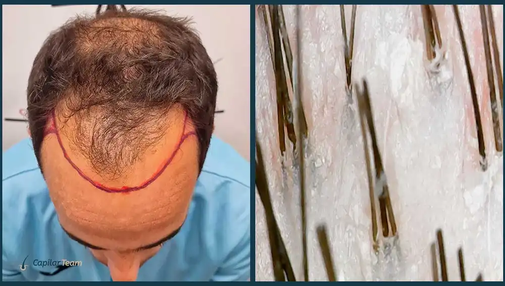 Vemos a Fernando en su primera consulta. En la imagen obtenida del tricoscopio, podemos ver que cuenta con una zona donante con 2/3 cabellos por folículo pilar, lo que le convierte en apto para una cirugía
