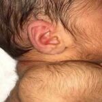 Bebé con hipertricosis 