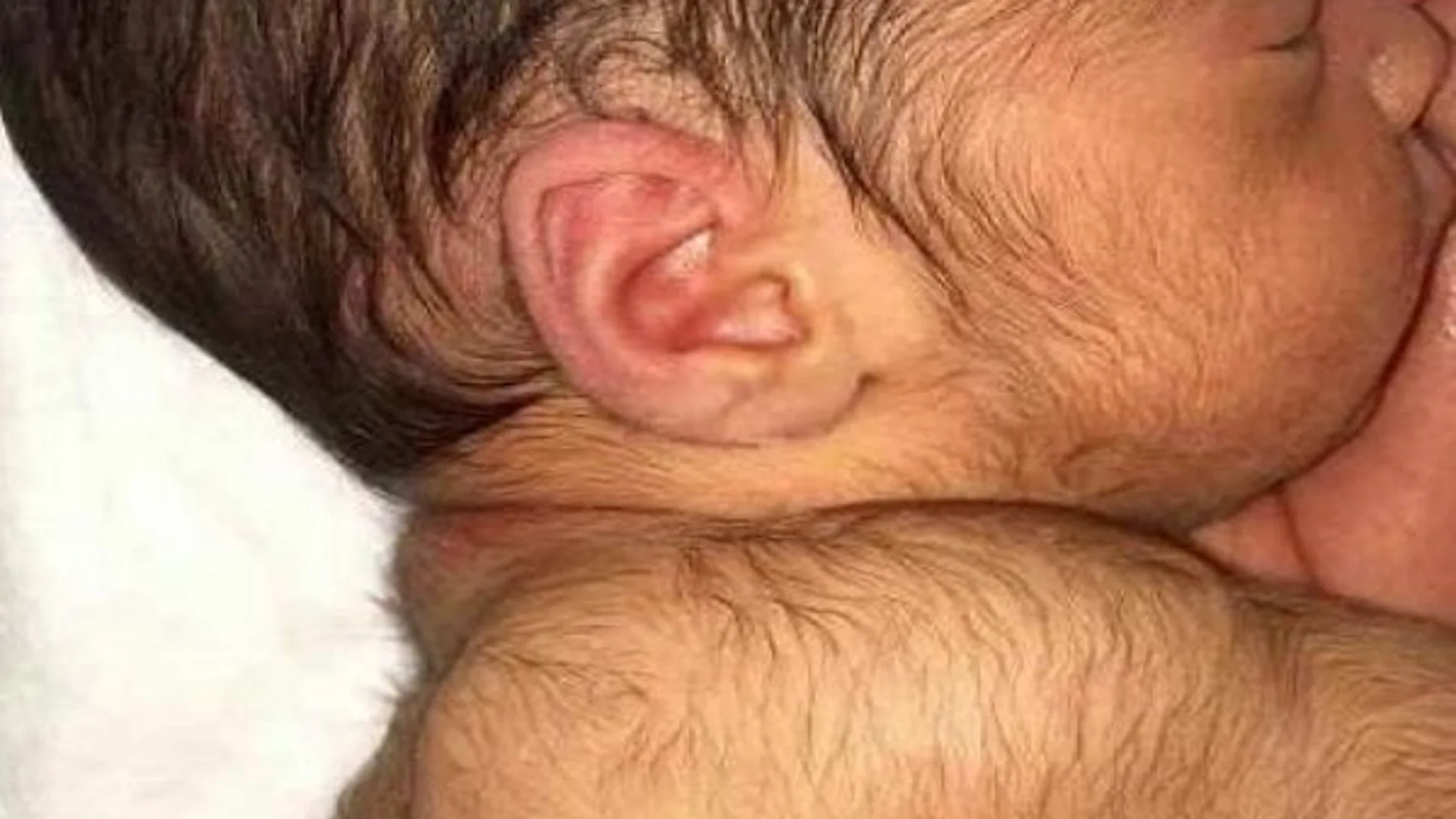 Bebé con hipertricosis