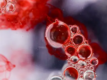 El mieloma múltiple es la segunda neoplasia hematológica más frecuente El mieloma múltiple es la segunda neoplasia hematológica más frecuente