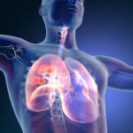 El cáncer de pulmón