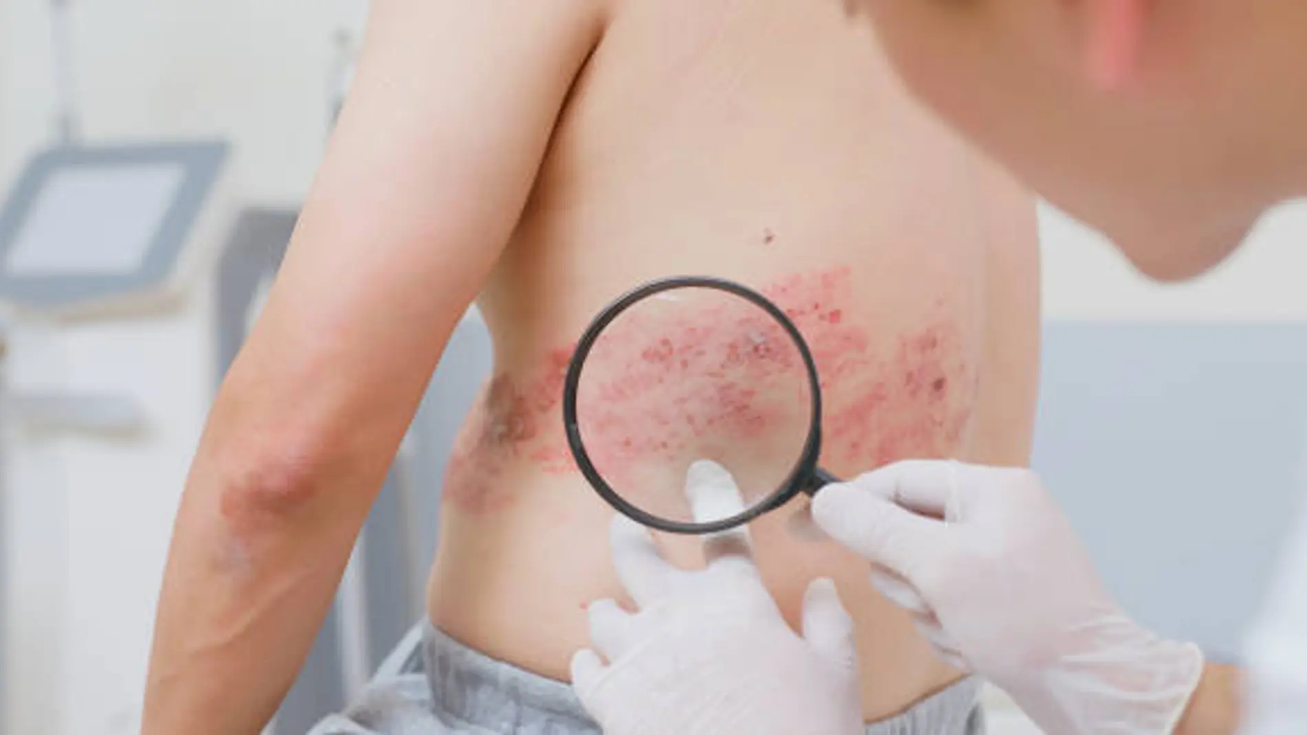 Herpes Zóster