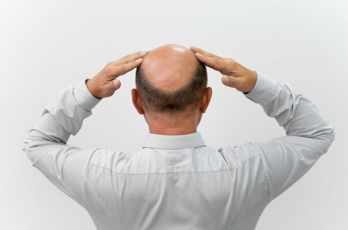 Calvicie o alopecia
