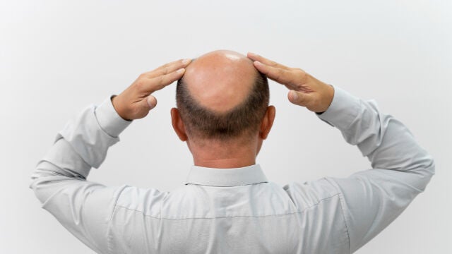Calvicie o alopecia
