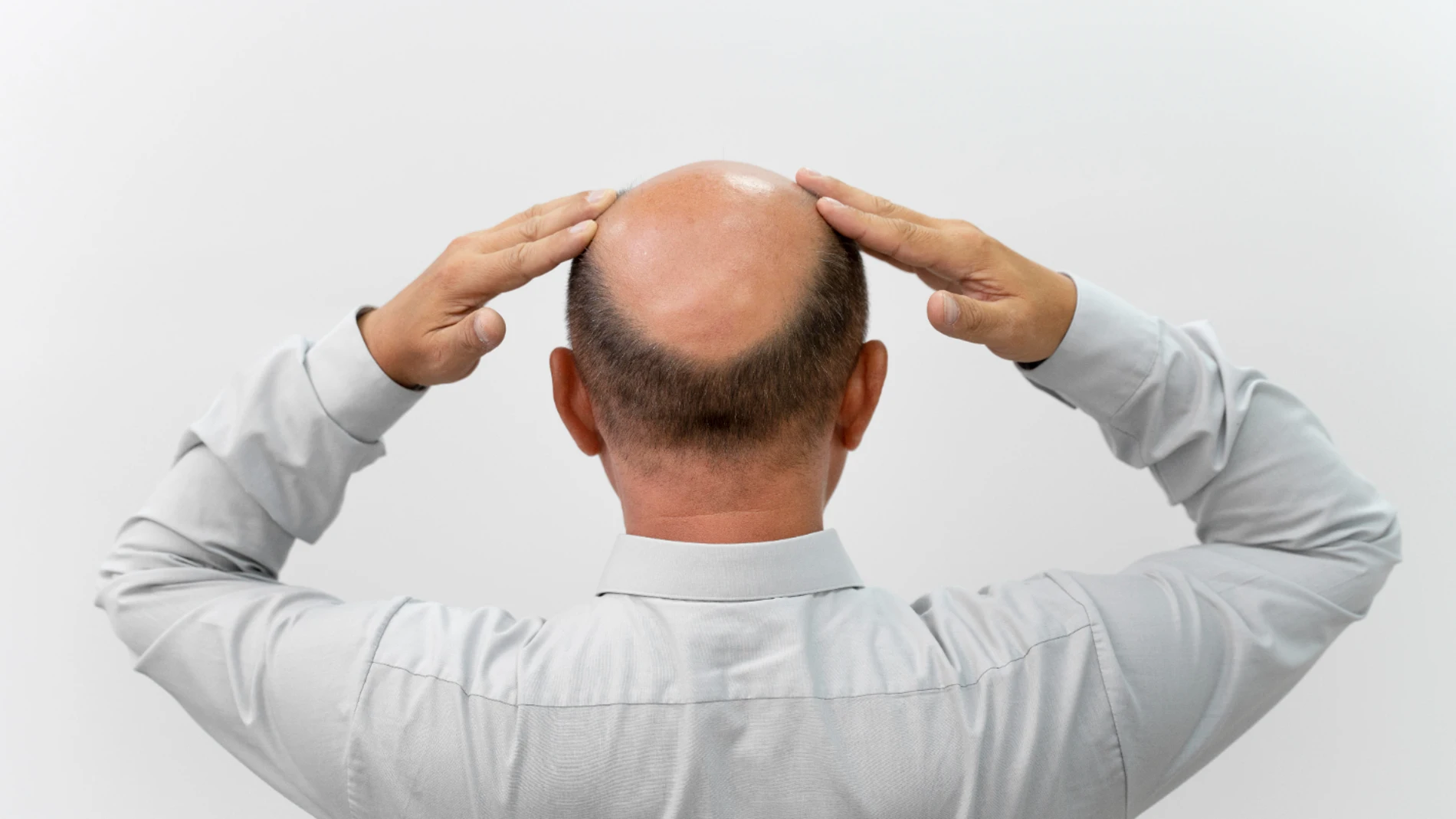 Calvicie o alopecia