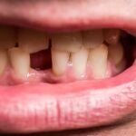 Qué significa soñar que se te caen los dientes según la astrología