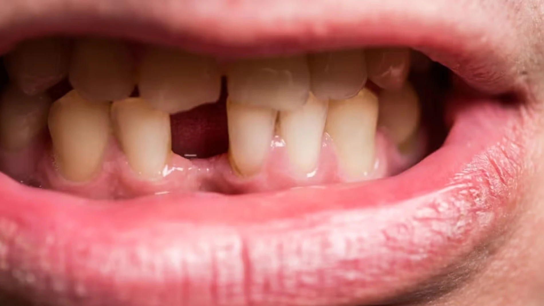 Qué significa soñar que se te caen los dientes según la astrología