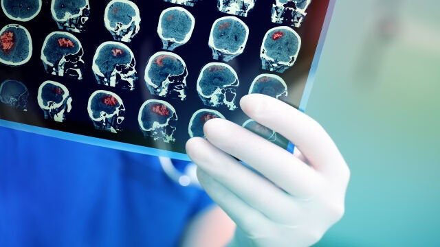 La met&aacute;stasis cerebral es un tumor cerebral secundario