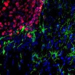 Células de la microglía (en verde) infiltrándose entre las células tumorales de una metástasis de melanoma (en rojo)